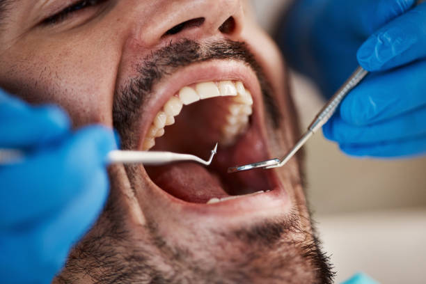 Best Emergency Wisdom Teeth Removal in Annapolis Neck, MD